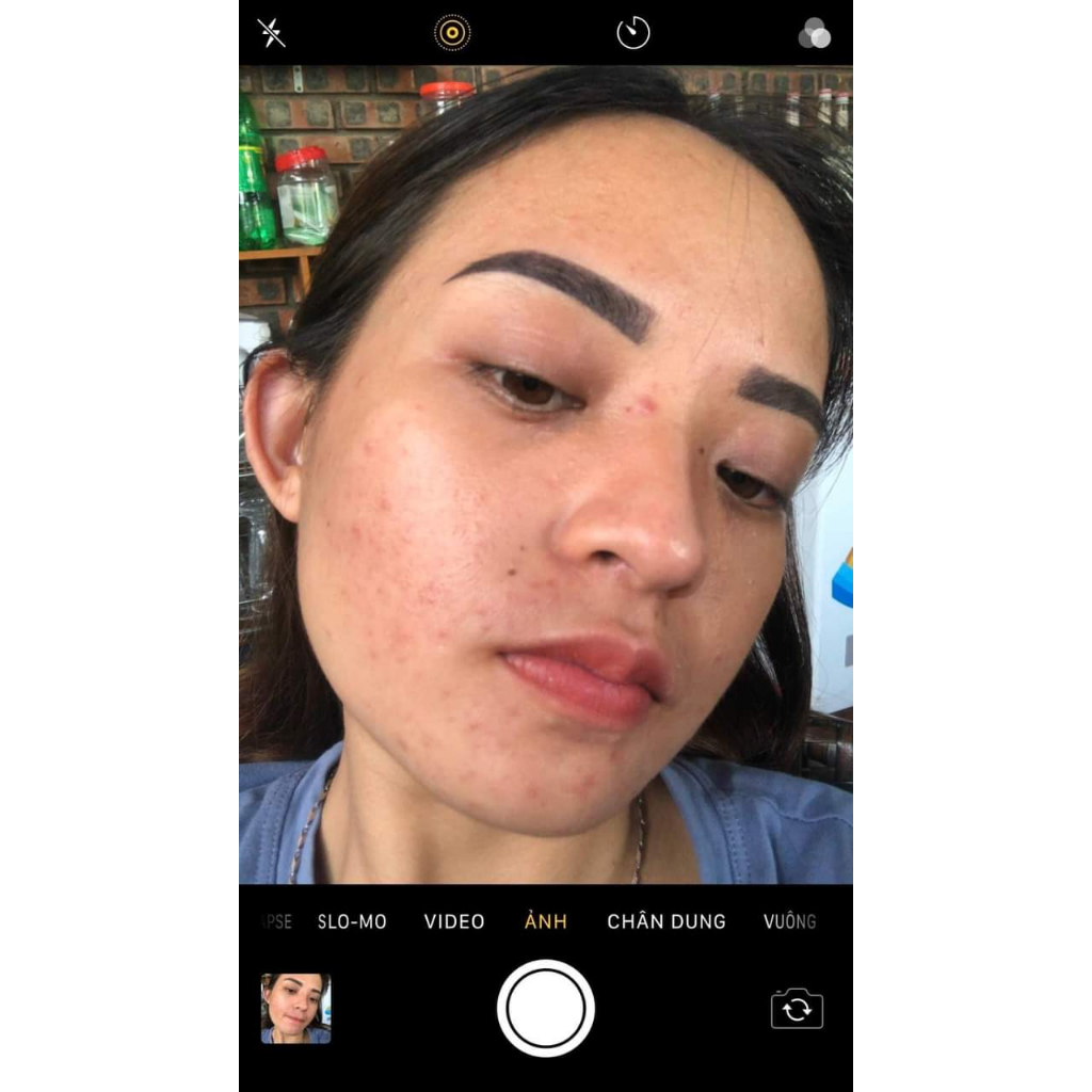 Serum giảm mụn thâm rỗ - Skin 7 Days - Công dụng 5 trong 1 hiệu quả sau 7 ngày