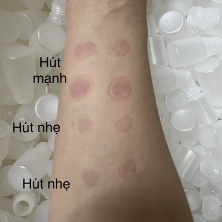 Ống nhựa hút mụn, ống hút máu bầm dùng trong Spa, Thẩm mỹ viện