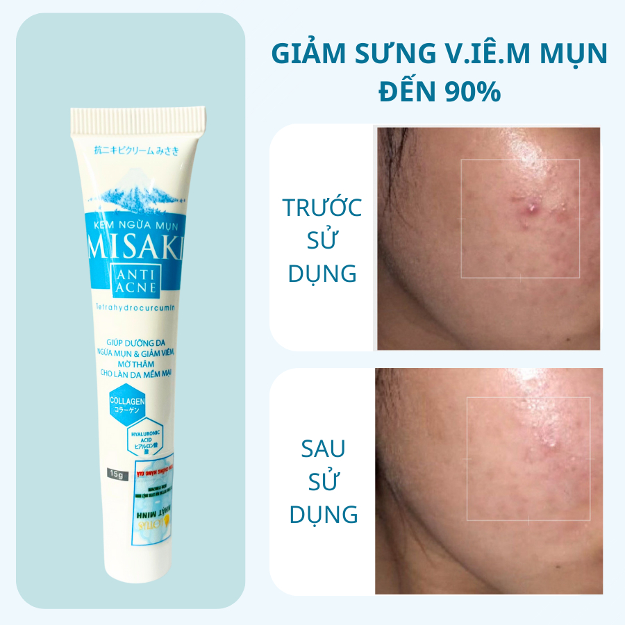 Kem mụn MISAKI collagen giảm mụn, ngừa thâm, mờ sẹo  - Phù hợp mọi loại da - 15g - Uy Phát Pharma