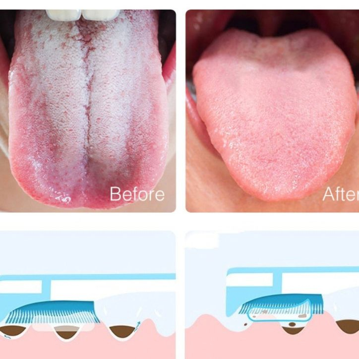 Combo gel cạo lưỡi đánh bay mảng bám, vi khuẩn và bụi bẩn tạo hơi thở thơm mát