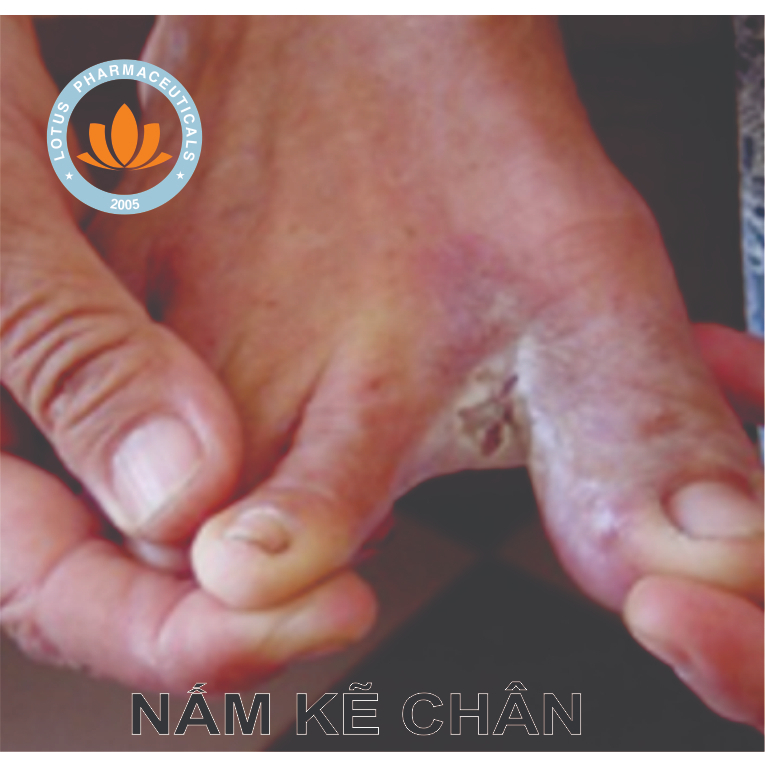 Ketoconazol - Kem Bôi Da | Lotuspharma