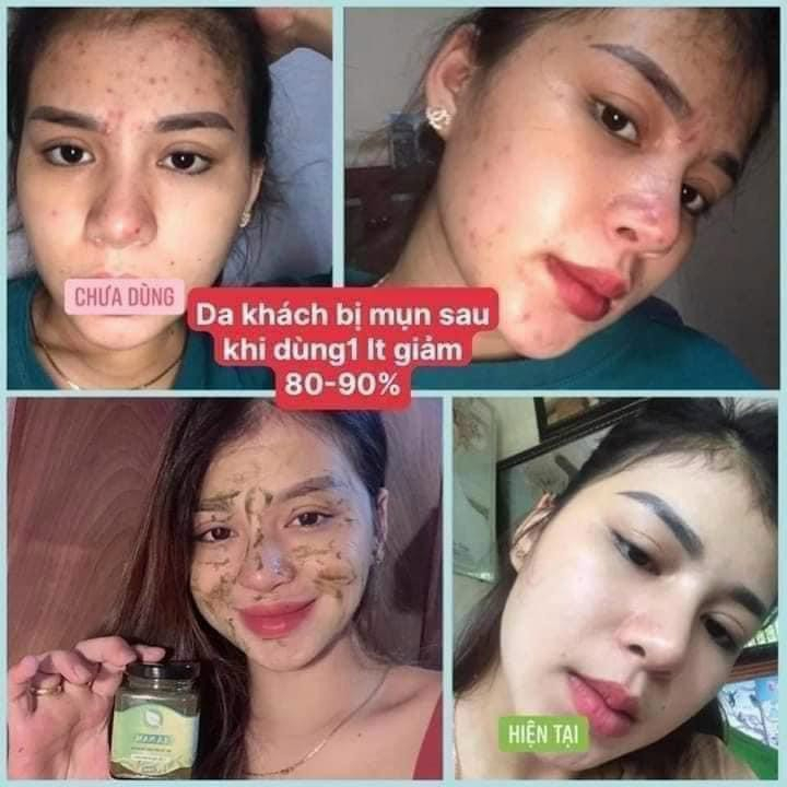 CAO LÁ NAM XOÁ NÁM, TÀN NHANG, THÂM MỤN tặng quà hấp dẫn
