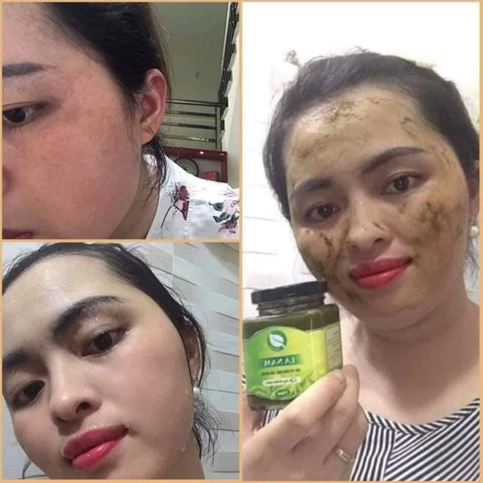 CAO LÁ NAM XOÁ NÁM, TÀN NHANG, THÂM MỤN tặng quà hấp dẫn
