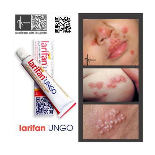 Larifan Ungo 10g Kem bôi Sùi mào gà, Mụn cóc sinh dục, Herpes.