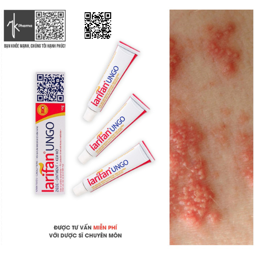 Larifan Ungo 10g Kem bôi Sùi mào gà, Mụn cóc sinh dục, Herpes.