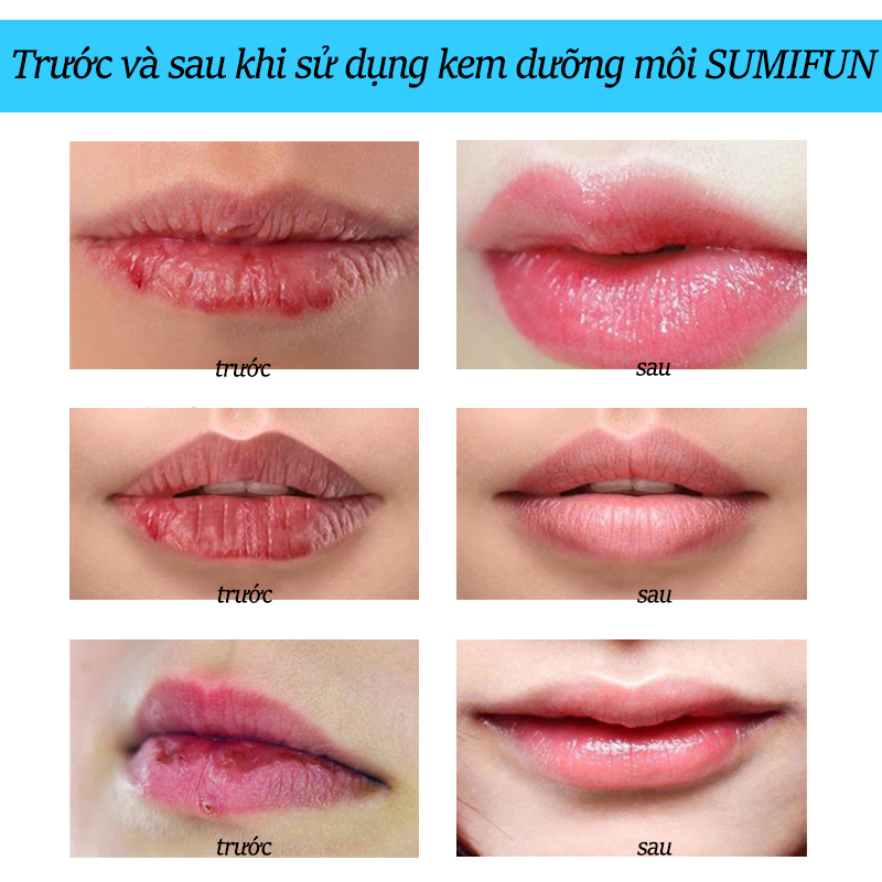 Kem Dưỡng Môi SUMIFUN Cheilitis Cream 20g, Giúp Dưỡng Ẩm Cho Môi, Cải Thiện Tình Trạng Khô, Nứt Nẻ, Giảm Thâm Sạm Môi