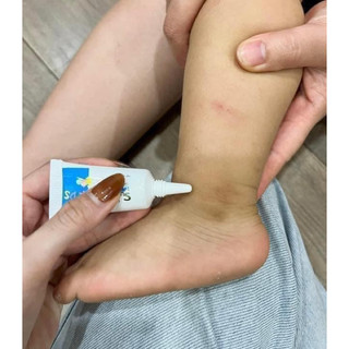 Kem kid scagel vết thâm cho bé 👼⛄️⛄️⛄️