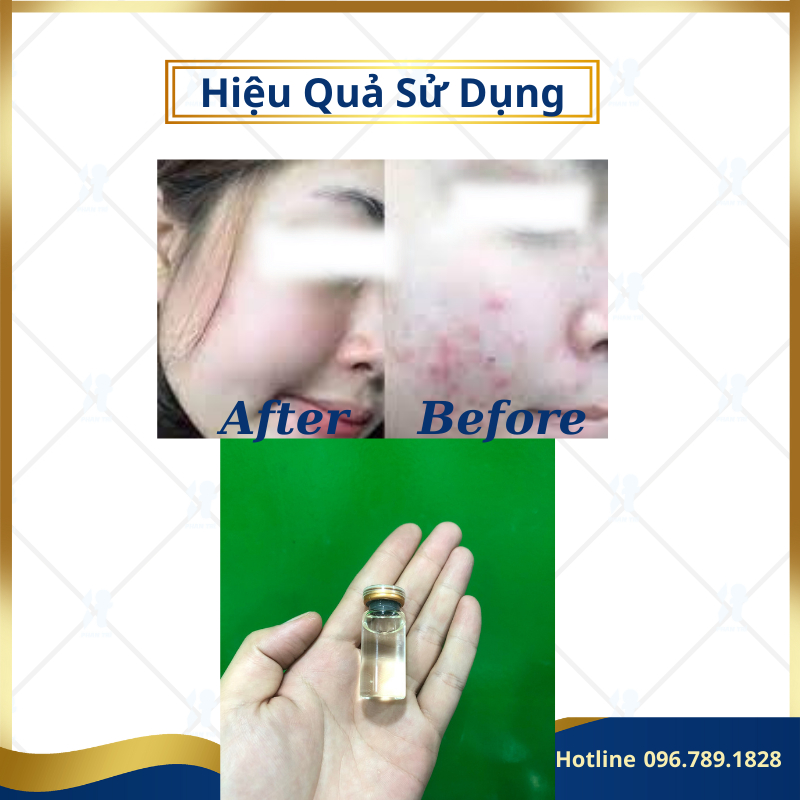 Serum trong mụn
