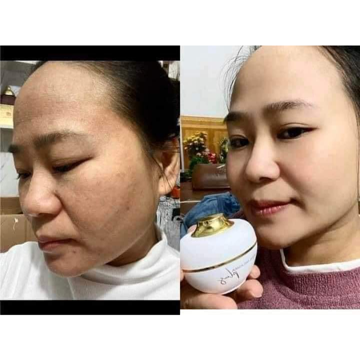 CAO NÁM MAGiC SKIN cao nám Royal Melasma Plus /-strong ngừa nám tàn nhang √ Size 13g