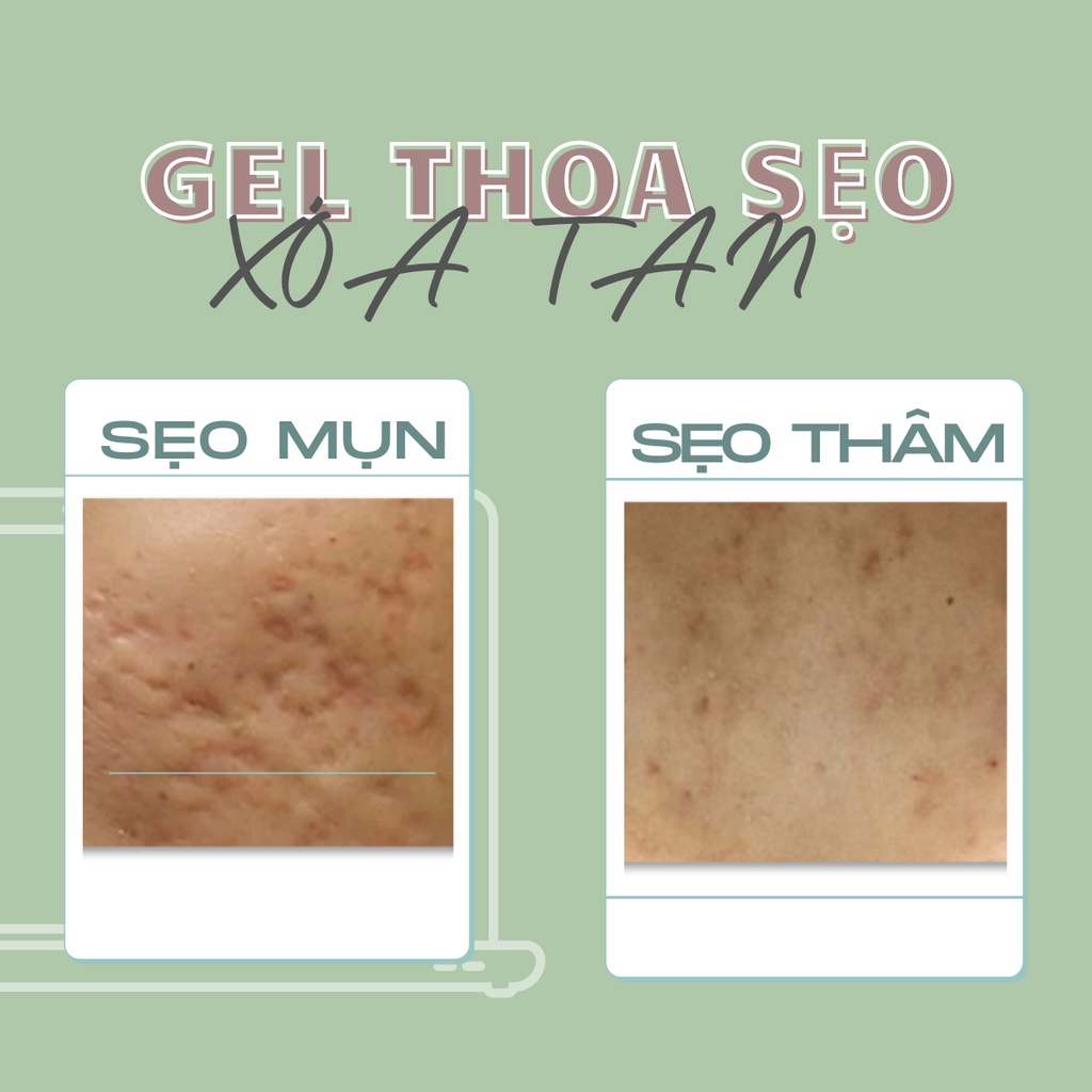 Kem mờ sẹo Vitara SE gel thoạ sẹo thâm rỗ giảm quá trình hình thành sẹo, mờ sẹo thâm, sẹo mụn 5g hoặc 15g