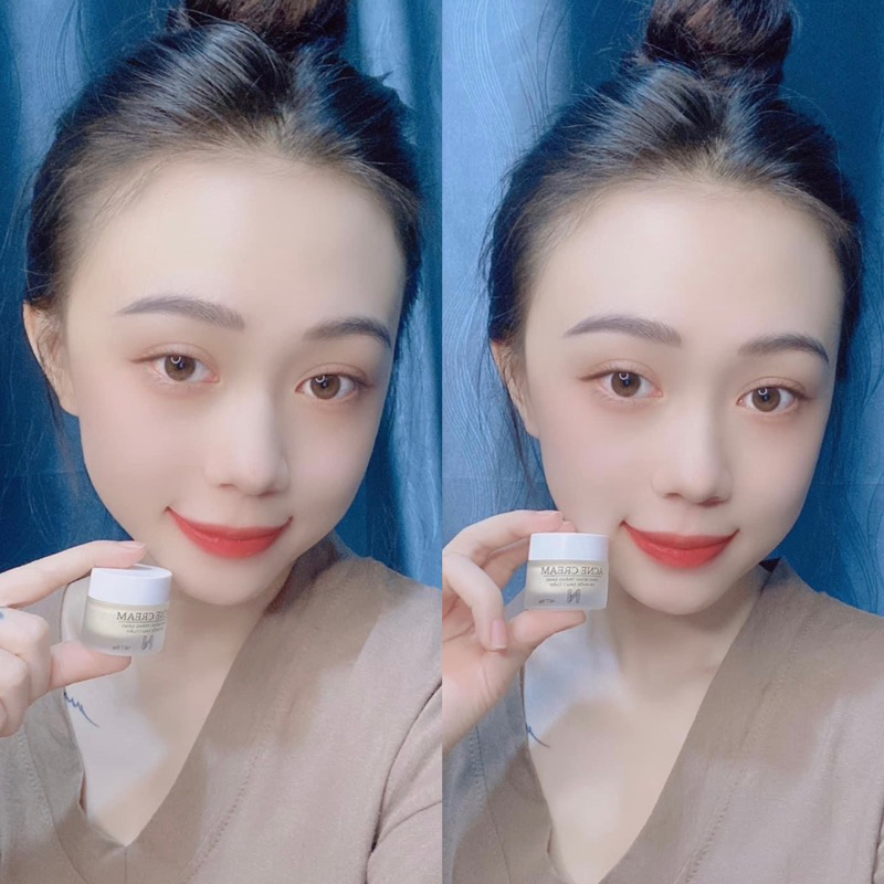 Face Mụn N