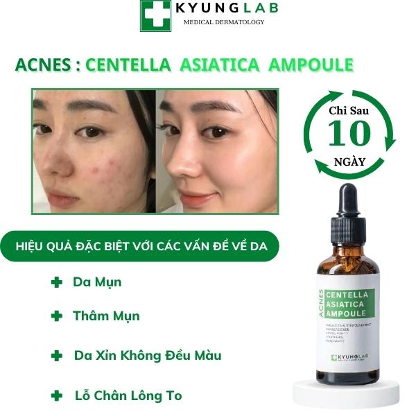 Serum, Serum ngừa mụn thâm Acnes Centella Aisatica Ampoule 50ml Kyung Lab siêu kiềm dầu, làm dịu, giảm sưng viêm, mụn, t