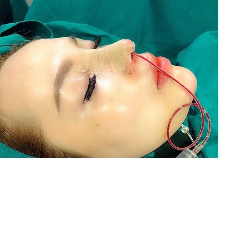 Nẹp mũi, sáp cầm máu mũi, dây dẫn dịch mũi, băng keo nâu 3M, băng keo trắng