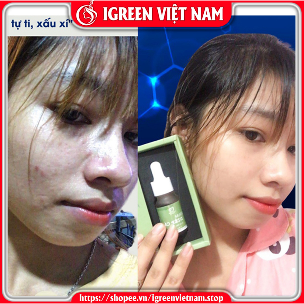 Serum diếp cá igreen, giảm mụn ẩn, mụn thâm, trứng cá, mụn bọc, mụn mủ, giúp se khít lỗ chân lông, dành da dầu, mẹ bầu
