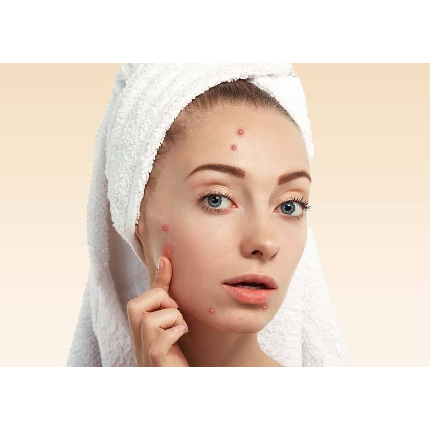 Kem dưỡng da mặt Azelaic Acid 20% Cream 30g Làm mờ vết mụn