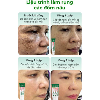 Kem Chấm Nám Tàn Nhang KT