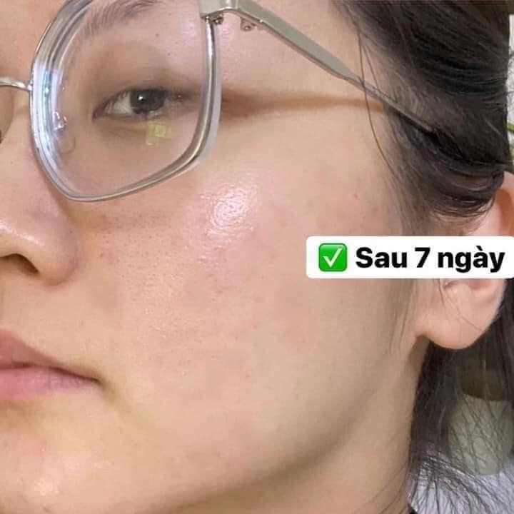 Kem Mụn Azclear 20% Azelaic Acid Mờ Thâm Và Giảm Mụn - 25g