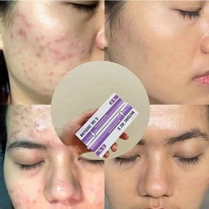 Gel Benzac Ac Giảm Mụn Bọc, Mụn Sưng Đỏ Benzoyl Peroxide 5% - Pháp