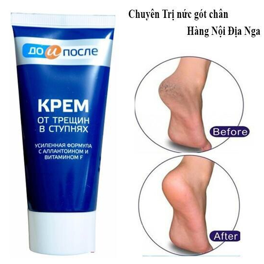 Kem nẻ gót chân Kpem Foot Cream giảm nẻ chân, nứt chân, khô da chân, dưỡng gót chân