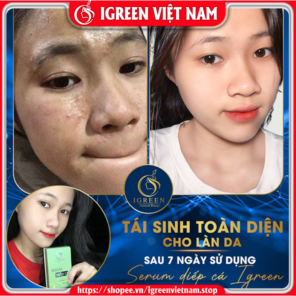 Combo Sữa rửa mặt Serum giúp sạch sâu loại bỏ bụi bẩn và bã nhờn trên da ngăn ngừa mụn giảm viêm sưng cho da mền mịn