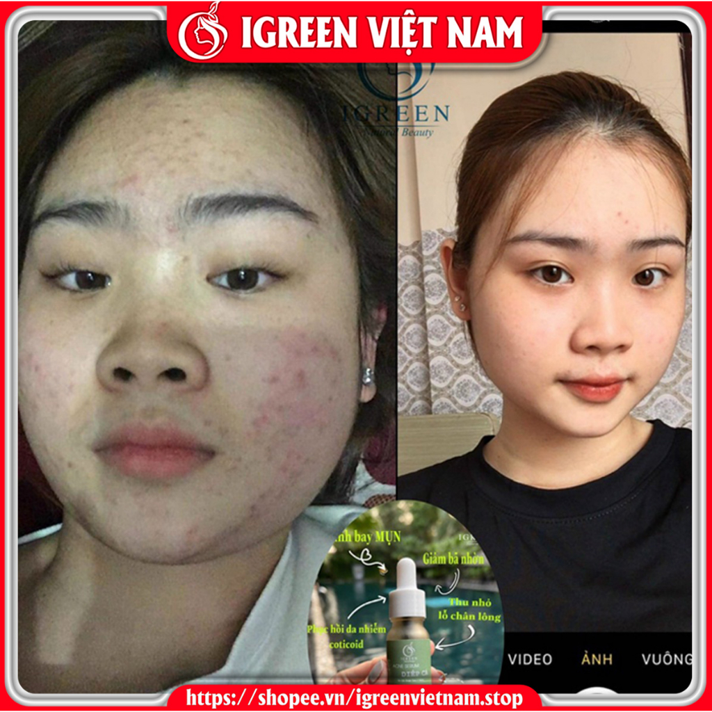 Combo Sữa rửa mặt Serum giúp sạch sâu loại bỏ bụi bẩn và bã nhờn trên da ngăn ngừa mụn giảm viêm sưng cho da mền mịn