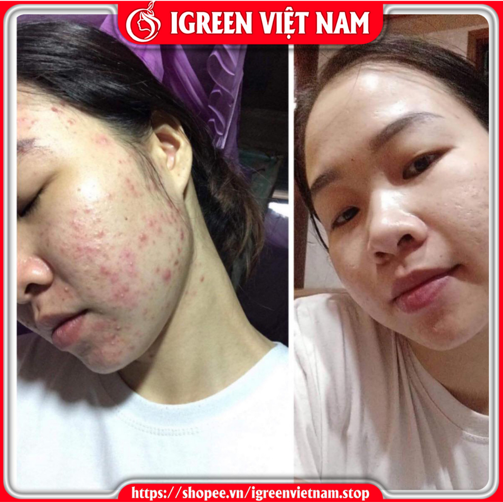 Combo Sữa rửa mặt Serum giúp sạch sâu loại bỏ bụi bẩn và bã nhờn trên da ngăn ngừa mụn giảm viêm sưng cho da mền mịn