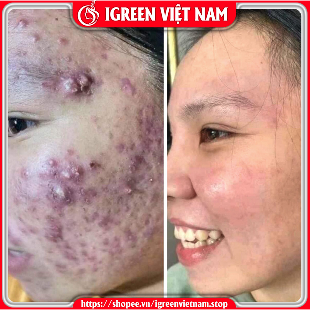 Combo Sữa rửa mặt Serum giúp sạch sâu loại bỏ bụi bẩn và bã nhờn trên da ngăn ngừa mụn giảm viêm sưng cho da mền mịn