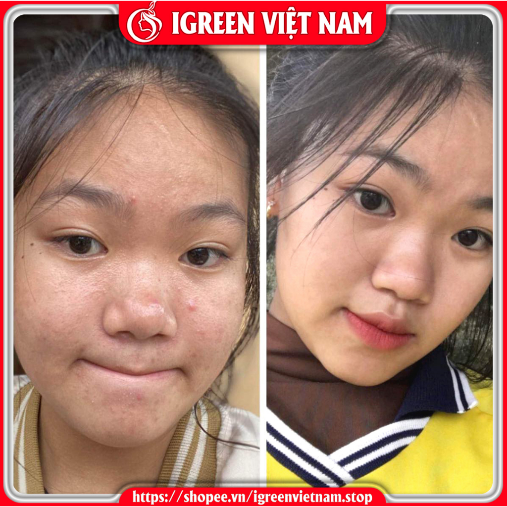 Combo Sữa rửa mặt Serum giúp sạch sâu loại bỏ bụi bẩn và bã nhờn trên da ngăn ngừa mụn giảm viêm sưng cho da mền mịn