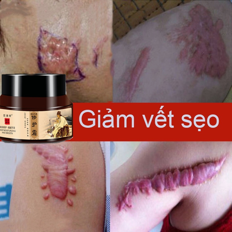 Kem xóa sẹo Kem sẹo Scar Care 50g sẹo do bị thương sẹo bỏng sẹo phẫu thuật sửa chữa tất cả