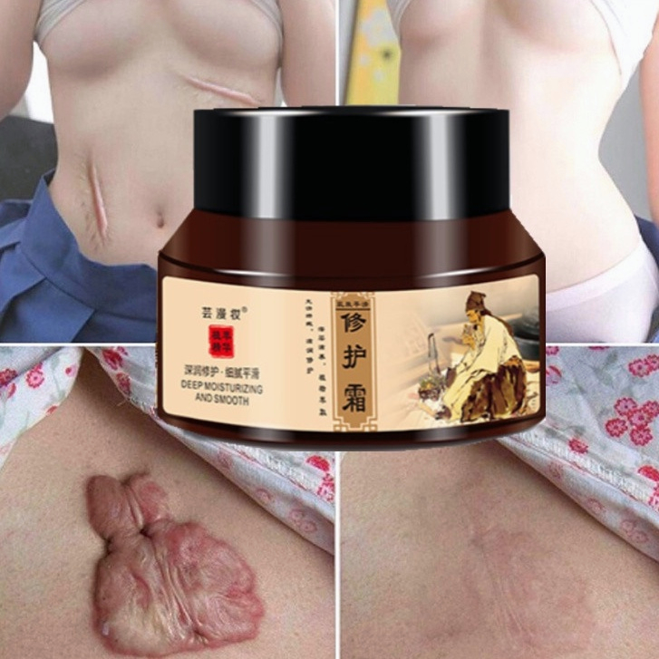 Kem xóa sẹo Kem sẹo Scar Care 50g sẹo do bị thương sẹo bỏng sẹo phẫu thuật sửa chữa tất cả