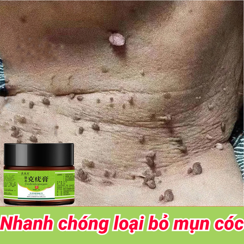 Kem mụn cóc Gel tẩy mụn ruồi kem xóa nốt ruồi Nga mụn cóc mụn thịt tàn nhang cam kết hàng chính hãng hiệu quả cao