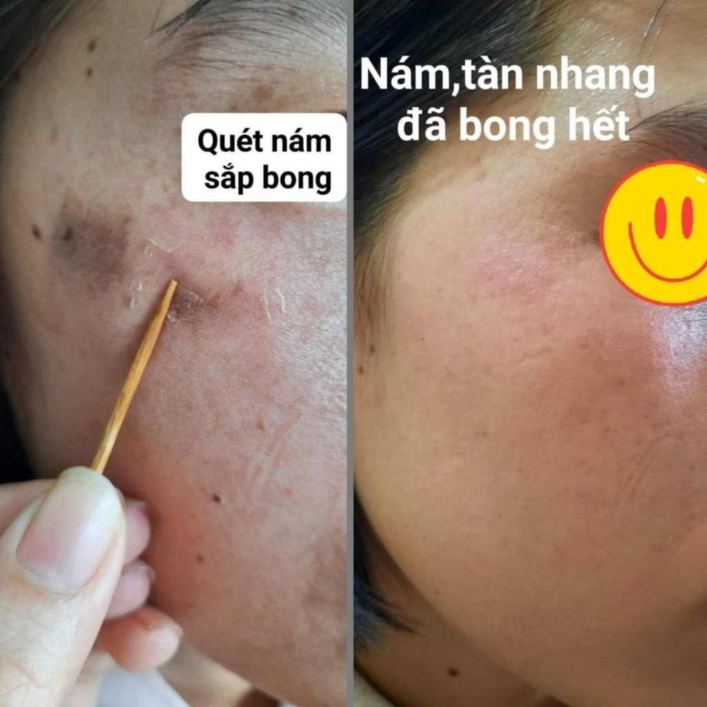 Chấm nám tàn nhang 1ml TCA Tichi Beaute, sạch nám, sạch tàn nhang