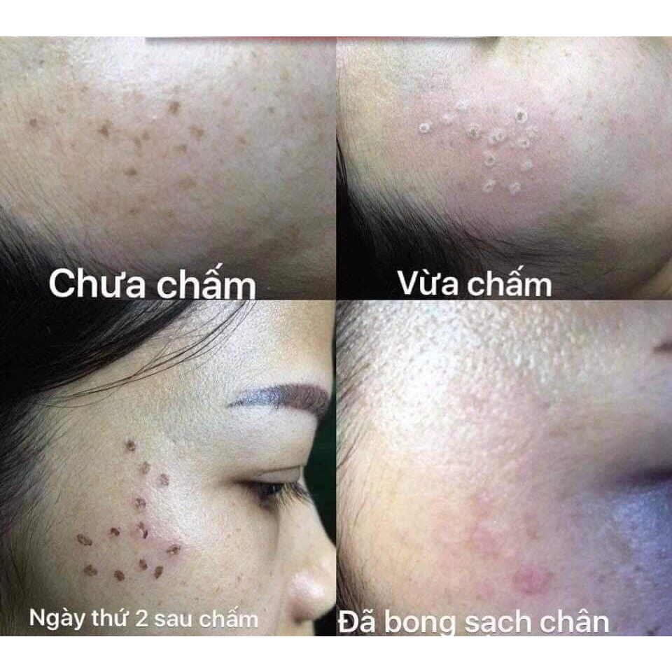 Chấm nám tàn nhang 1ml TCA Tichi Beaute, sạch nám, sạch tàn nhang