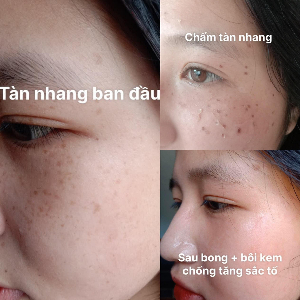 Chấm nám tàn nhang 1ml TCA Tichi Beaute, sạch nám, sạch tàn nhang