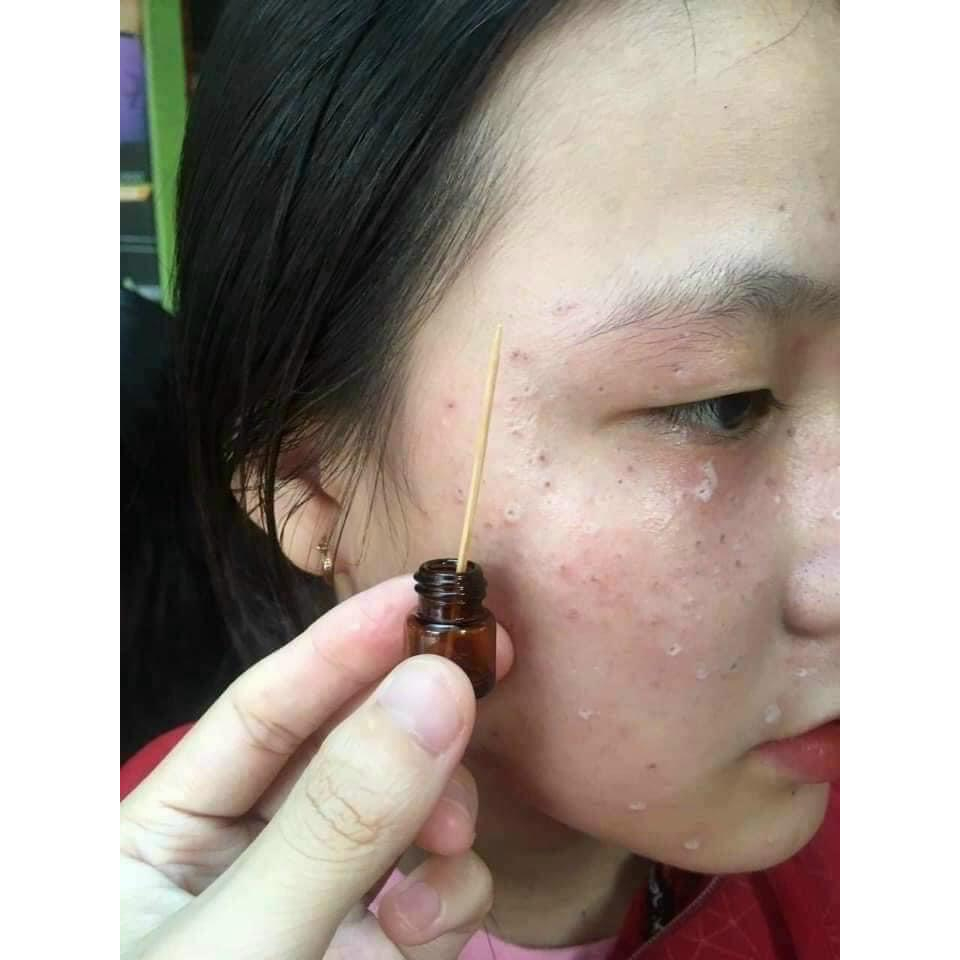 Chấm nám tàn nhang 1ml TCA Tichi Beaute, sạch nám, sạch tàn nhang