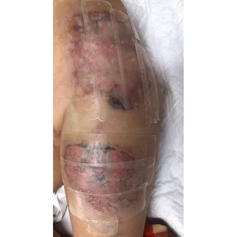 Miếng dán hút dịch chống loét DUO-SKIN Hydrocolloid dressing  10x10cm