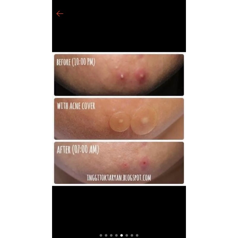 Miếng dán hút dịch chống loét DUO-SKIN Hydrocolloid dressing  10x10cm