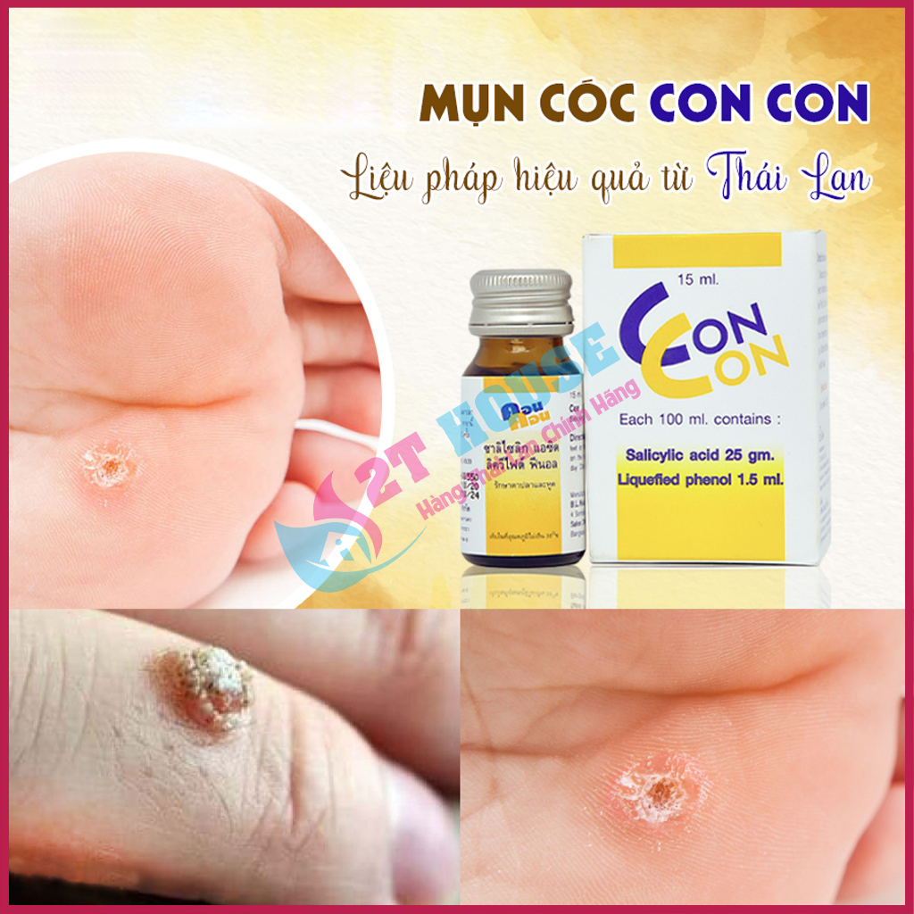 Dầu bôi giảm mụn cóc/mụn nước/sùi mào gà Con Con Thái Lan chai 15ml 2T House Shop Hàng Thái Lan Nội Địa Chính Hãng