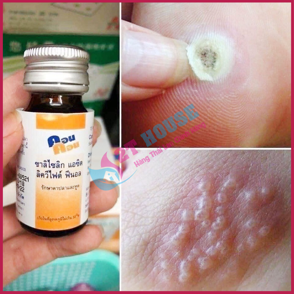 Dầu bôi giảm mụn cóc/mụn nước/sùi mào gà Con Con Thái Lan chai 15ml 2T House Shop Hàng Thái Lan Nội Địa Chính Hãng