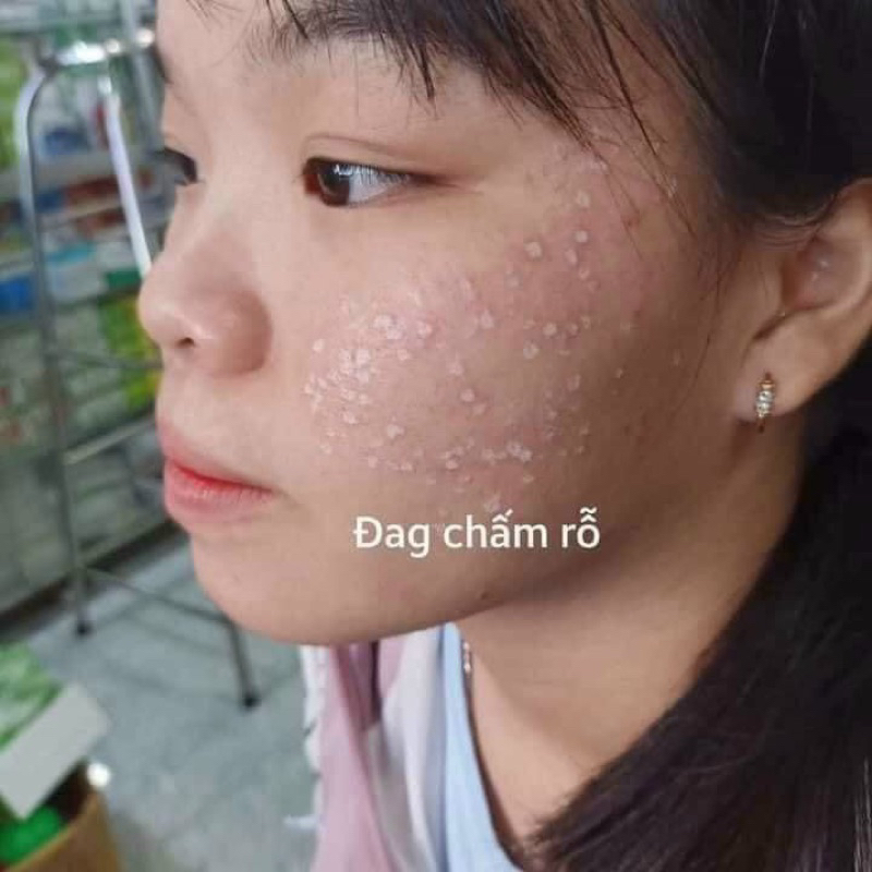 TCA chấm rỗ, nám đinh, tàn nhan ..2ml handmade spa