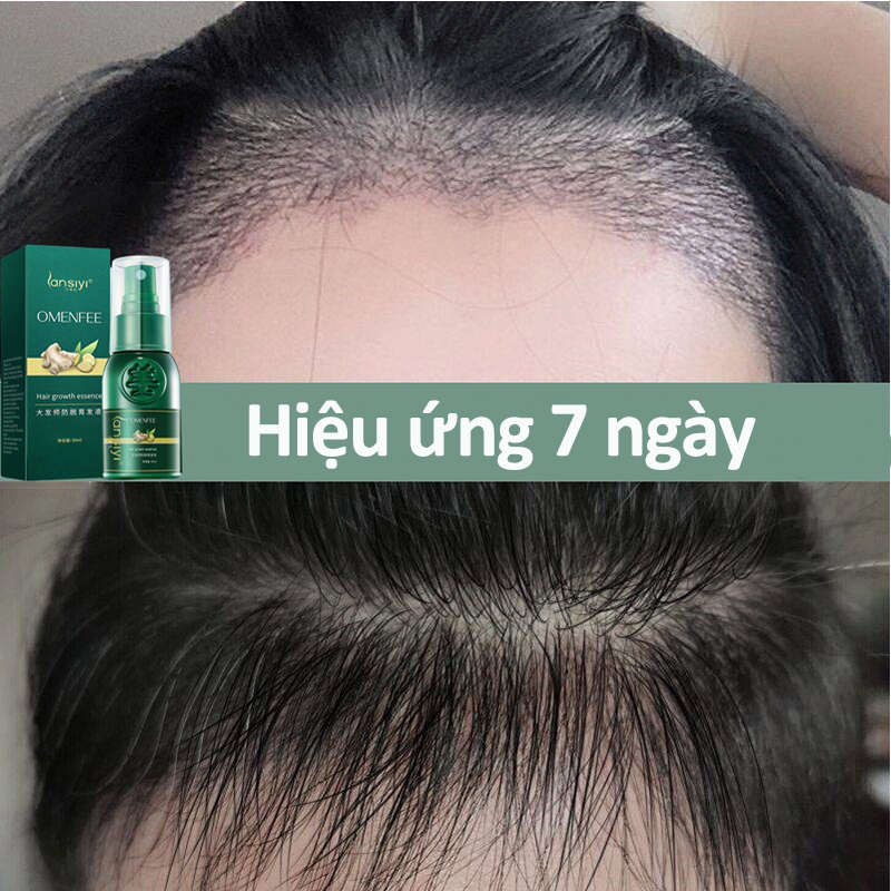 「Đảm bảo xác thực」Thuốc mọc tóc serum mọc tóc tinh chất mọc tóc dưỡng tóc chống rụng tóc kích mọc tóc nhanh ph