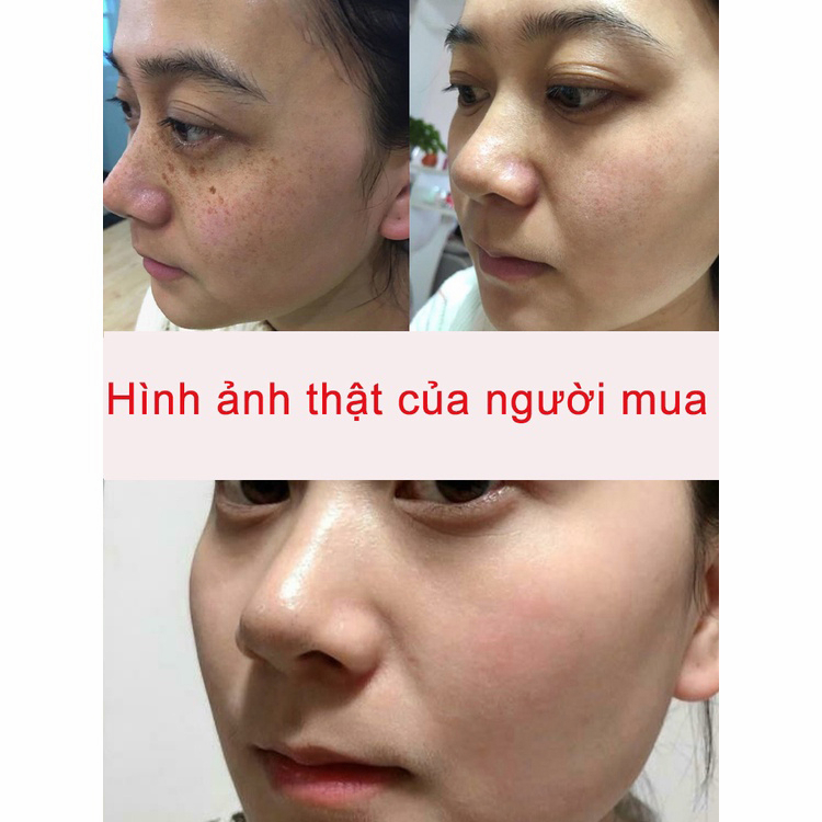 Tinh chất làm trắng sạch tàn nhang 20g Kem trắng da và xóa tàn nhang, Hiệu quả làm mờ thâm nám tàn nhan, Kem nám tàn n