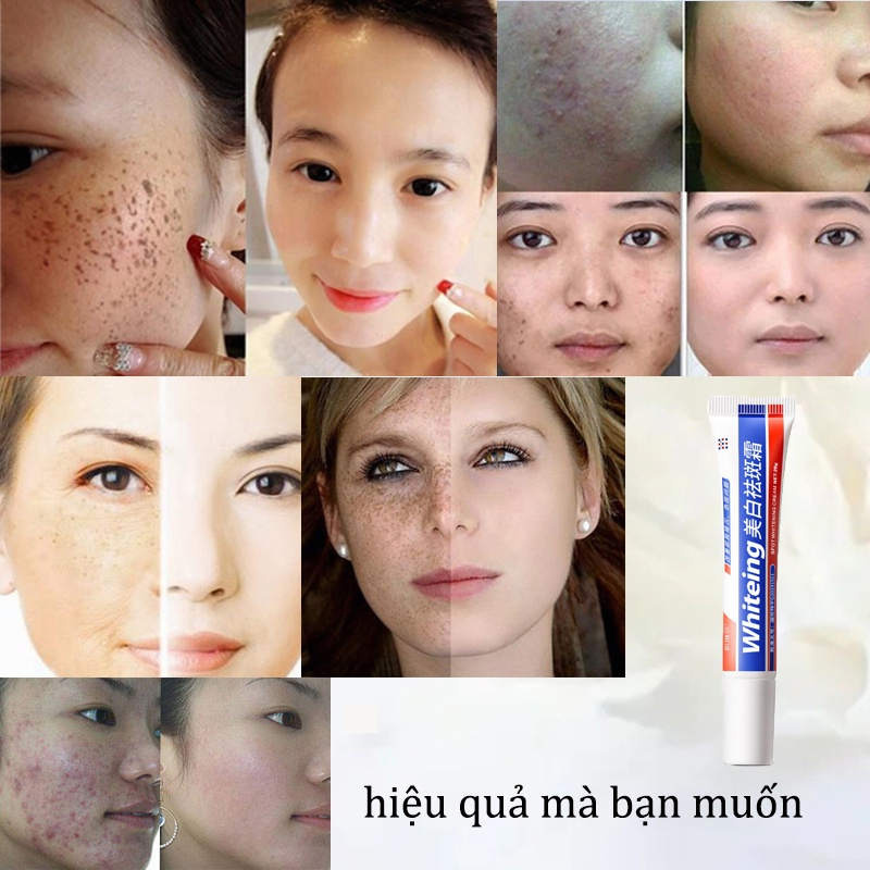 Tinh chất làm trắng sạch tàn nhang 20g Kem trắng da và xóa tàn nhang, Hiệu quả làm mờ thâm nám tàn nhan, Kem nám tàn n