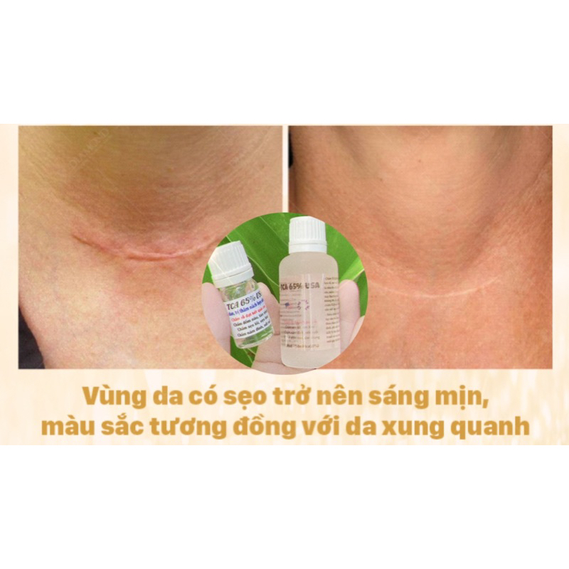 𝐓𝐂𝐀 𝐂𝐇𝐀̂́𝐌 𝐍𝐀́𝐌 - 𝐂𝐇𝐀̂́𝐌 𝐓𝐀̀𝐍 𝐍𝐇𝐀𝐍𝐆 rỗ, peell da hết thâm, nách bẹn handmade