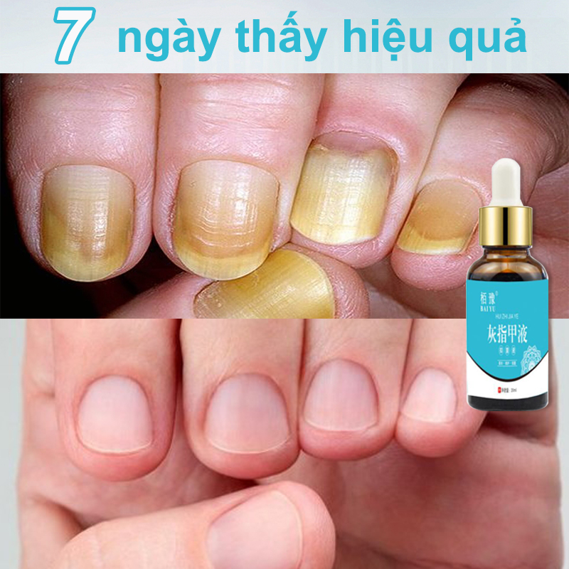Kem nấm móng tay dưỡng móng tay thảo dược kháng khuẩn serum phục hồi móng chăm sóc chân 20ml