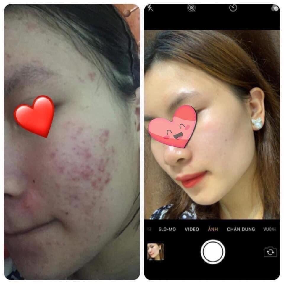 Tinh chất thảo dược Cao Lá Nam 5ml, giảm mụn thâm, giúp da trắng sáng