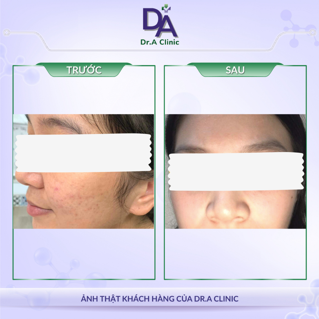 Sữa rửa mặt cho da dầu mụn nhạy cảm Cerave chính hãng Dr.A dòng Foaming Cleanser làm sạch sâu, kiềm dầu tốt