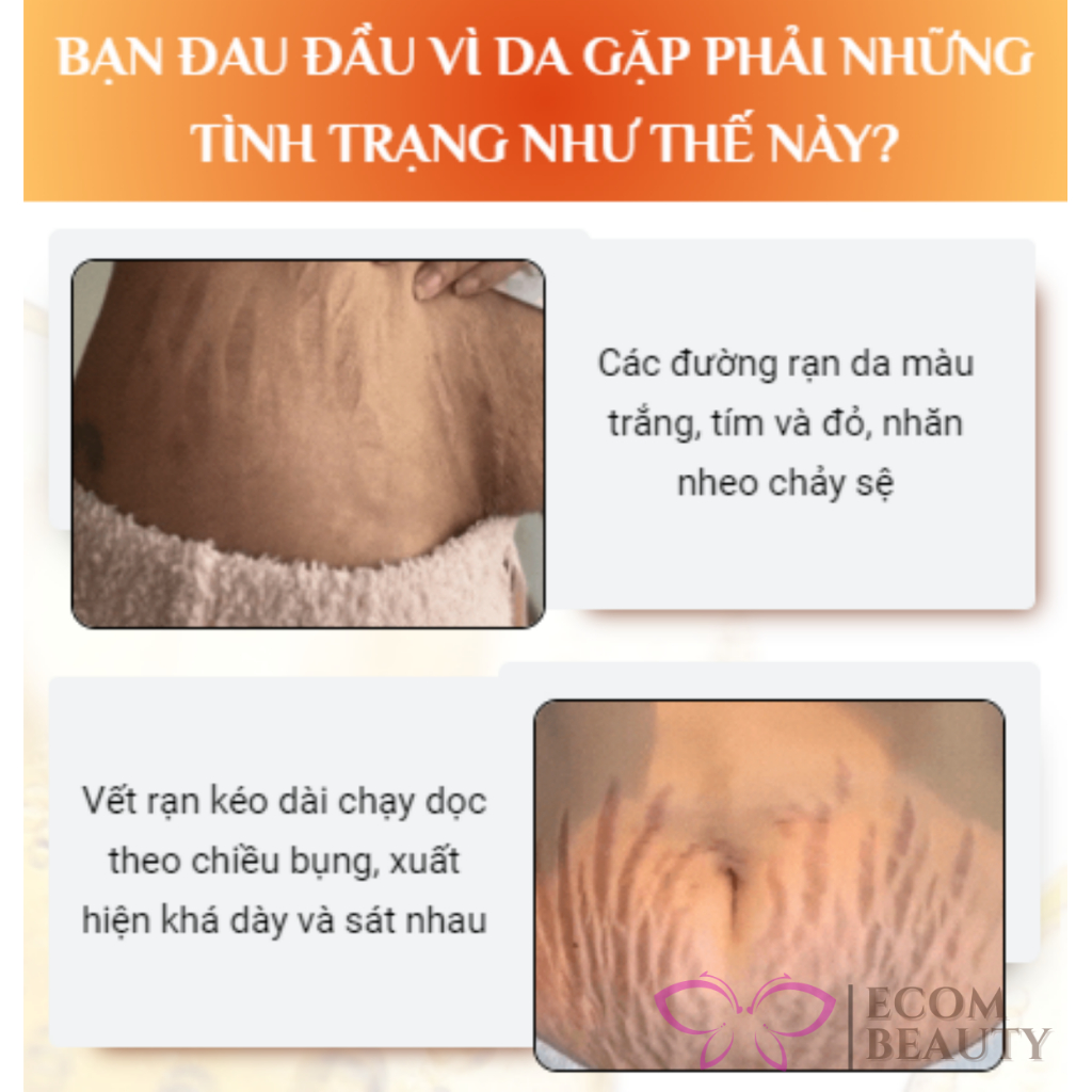 Tinh dầu rạn da Ôliu XROLAND - Serum đánh bay rạn da sau sinh, mờ thâm, tái tạo làn da săn chắc, đàn hồi - ECOM BEAUTY