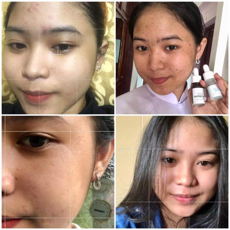 (Tặng kem serum sữa căng bóng) 𝐕𝐈 𝐊𝐈𝐌 𝐓𝐇𝐀̉𝐎 𝐃𝐔̛𝐎̛̣𝐂 TÁI TẠO DA thế hệ mới căng bóng, se lỗ chân lông, trắng sáng p