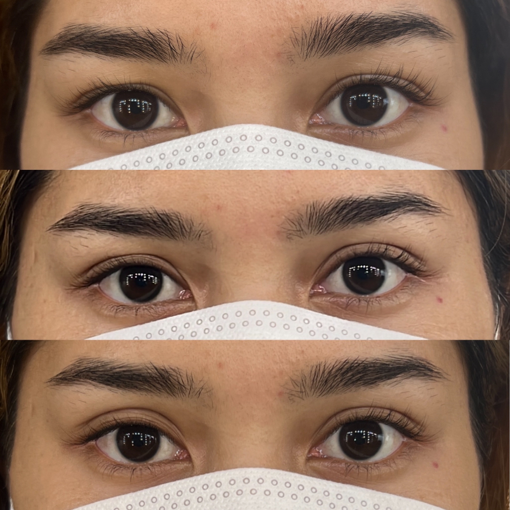 Invisible Eyelid tape